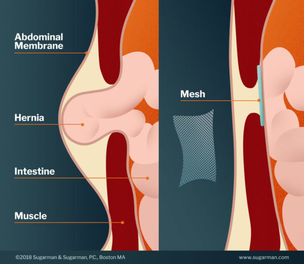 hernia-mesh-failures-and-injuries-sugarman